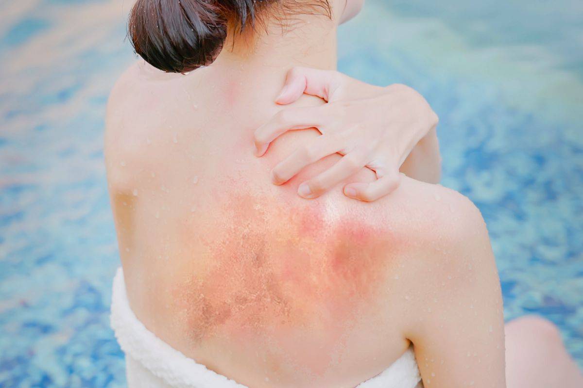 perché si può avere prurito in piscina